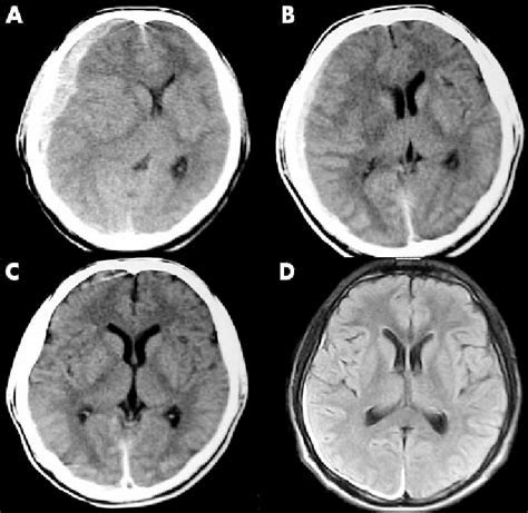 A Initial Ct Scan Shows Subdural Haematoma In The Right Download