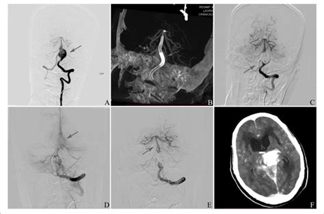 A Frontal Vertebral Arteriograms Showing A Dissecting Aneurysm At Download Scientific