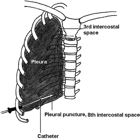 Endothoracic fascia | Semantic Scholar