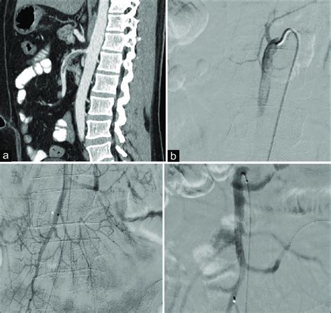 A Computed Tomography Angiogram Showing Superior Mesenteric Artery