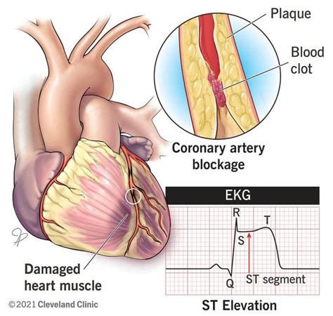 Nstemi Causes Symptoms Diagnosis Treatment Outlook 60 Off