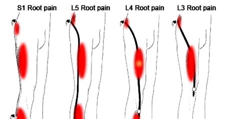 Sciatica Similar Symptoms Different Causes Studypk