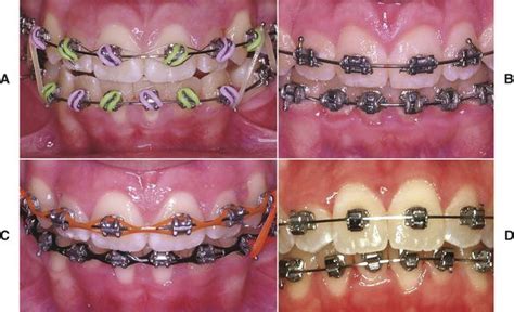 Orthodontic Appliances Pocket Dentistry