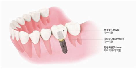 오스템임플란트 작년 치과용 임플란트 판매량 세계 1위 매일경제