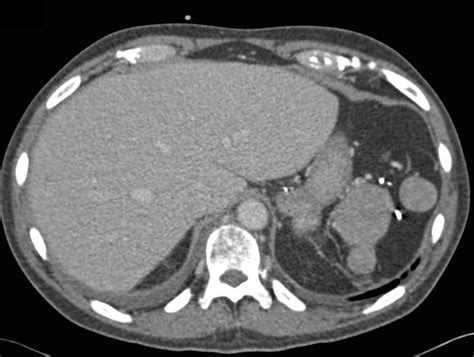 Beautiful Example Of Splenosis Spleen Case Studies Ctisus Ct Scanning