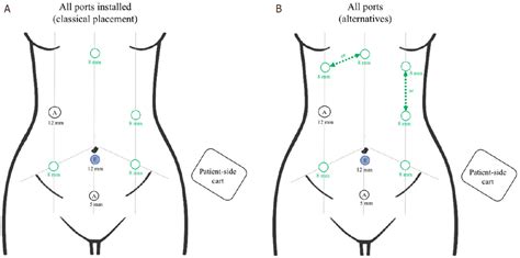 Robotic Assisted Abdominoperineal Resection Technique Feasibility