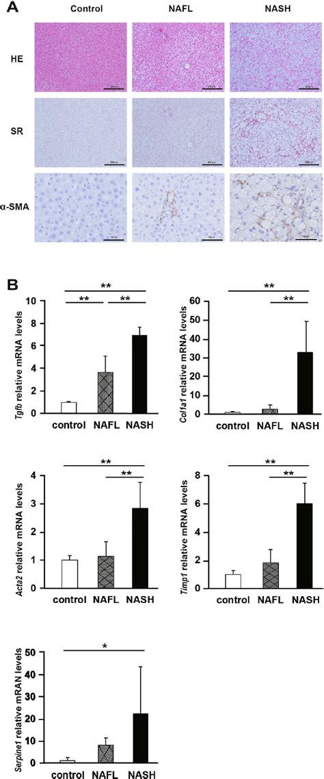 Liver Fibrosis And Activationoh Hepatic Stellate Cells Hscs In