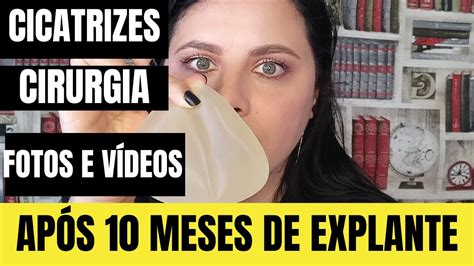 CICATRIZES APÓS 10 MESES DE CIRURGIA EXPLANTE DE SILICONE E MASTOPEXIA