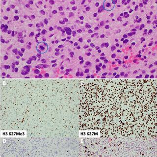 Histology Of Tumor A H E Stained Slide Demonstrating Anaplastic Glial