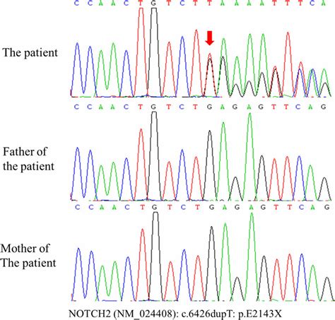 Chromatograms Of Notch Mutations Identified In The Patient The