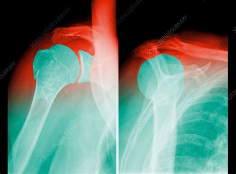 Shoulder luxation - Stock Image - C031/0303 - Science Photo Library