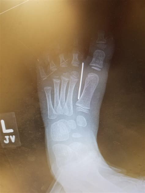A 3 year old's foot with a large needle stuck in it. OC : r/XRayPorn