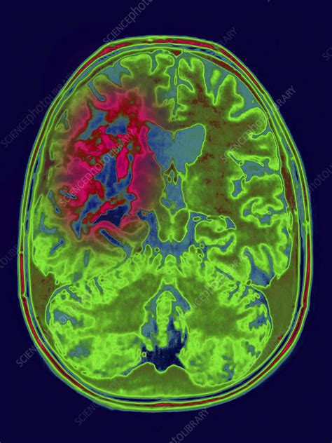 Astrocytoma Mri - Stock Image - C021/3875 - Science Photo Library