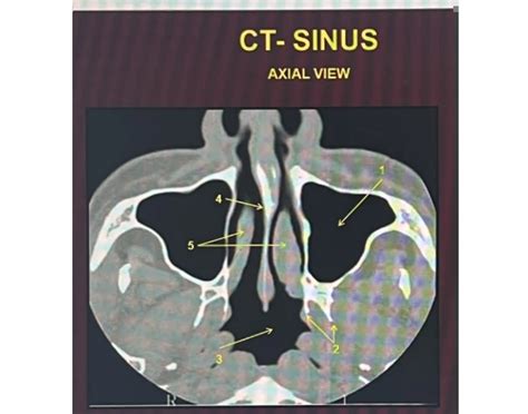 CT SINUS ANATOMY Quiz