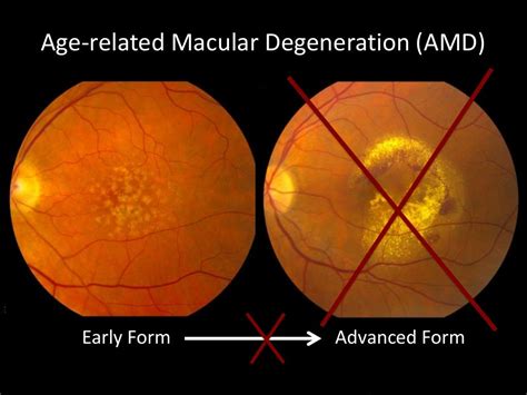 Age Related Macular Degeneration Amd Early