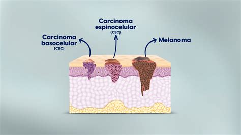 Dermatoscopia E Mapeamento Corporal Como Auxiliam No Diagn Stico Do