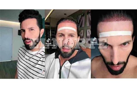 Poncho De Nigris Se Injerta Cabello Y Lo Comparan Con Yatra