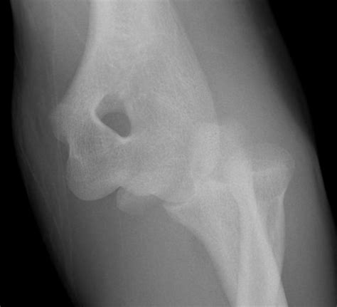 Medial Epicondyle Condyle Fracture The Bone School