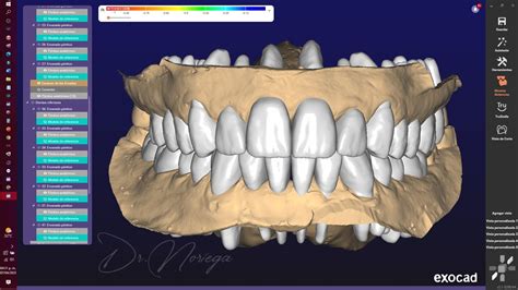 ENCERADO DIGITAL EXOCAD Dr Noriega Drnoriega Mx YouTube