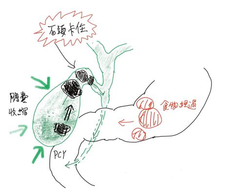 認識膽結石及膽結石去除手術的介紹 楊博智醫師的肝膽胰手術世界