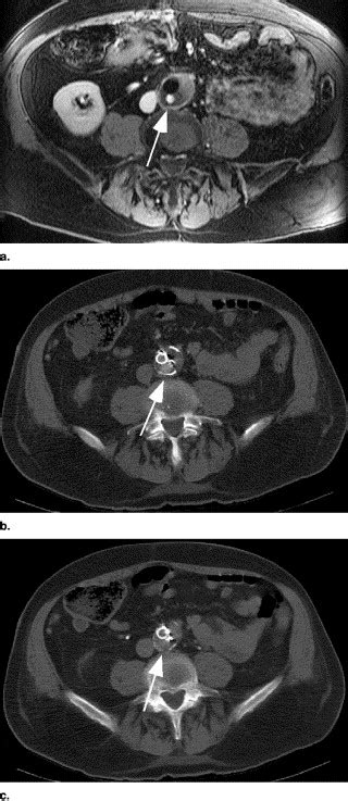 Mr Imaging For The Detection Of Endoleaks In Recipients Of Abdominal