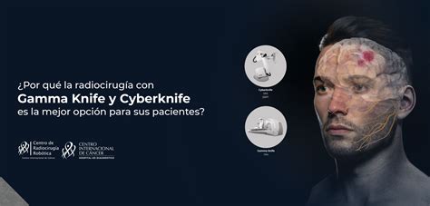 Radiocirugía Con Gamma Knife Y Cyberknife