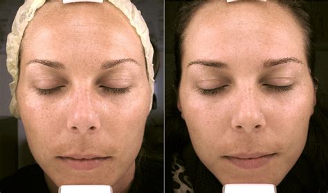 Mandelic Acid Peels Professional Mandelic Acid Peels In Chesterfield