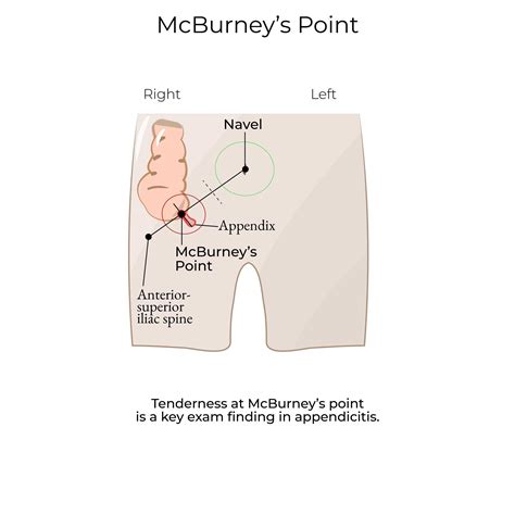 Clinical Pathology Glossary McBurney S Point Ditki Medical