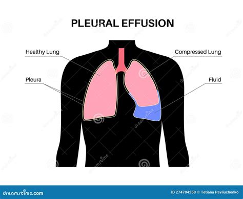 Pleural effusion poster stock vector. Illustration of pneumothorax - 274704258