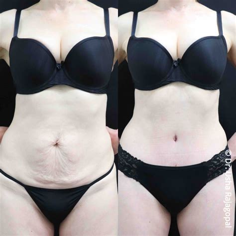 Tummy Tuck Abdominoplasty In San Francisco Bay Area Ca San