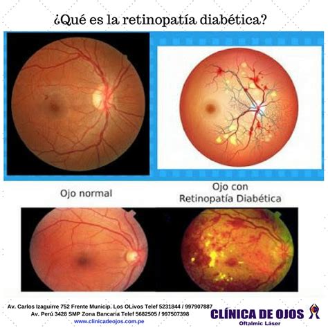 Clínica de Ojos Oftalmic Láser: ¿Qué es la retinopatía diabética?