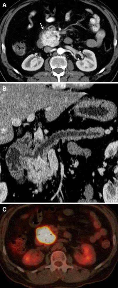 50 Year Old White Male With A Primary Retroperitoneal Paraganglioma Download Scientific Diagram