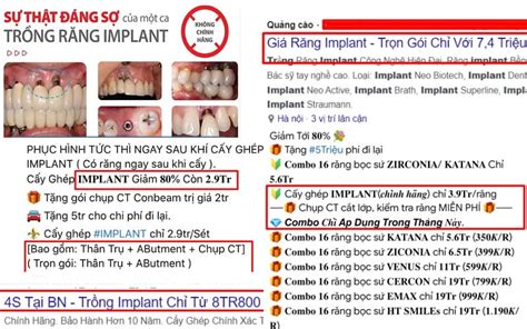 Loạn Giá Trồng Răng Nha Tặc Lộng Hành Gợi Ý Nha Khoa Trồng Răng Không