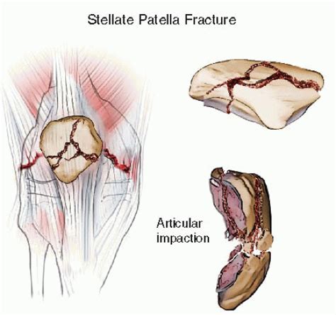 Patella Fractures Open Reduction Internal Fixation Musculoskeletal Key