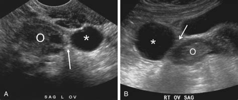 Ultrasound Evaluation Of The Fallopian Tube Radiology Key