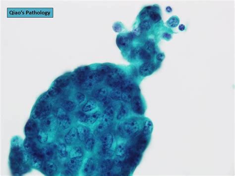 Qiao S Pathology Malignant Pleural Effusion With Metastatic Breast