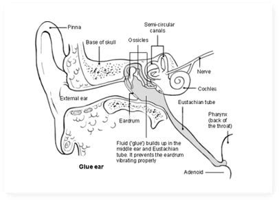 Glue Ear - Symptoms and Treatment - Otovent