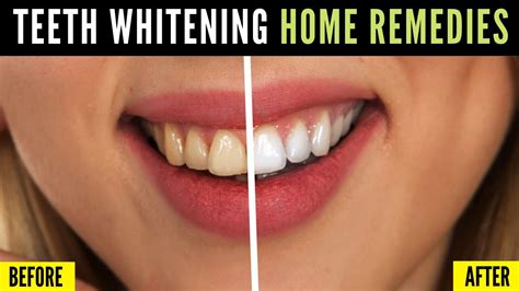 Home Remedies For Teeth Whitening All Natural 100 Works Youtube