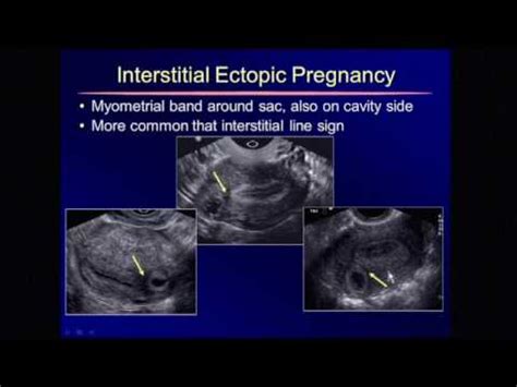 Cornual Ectopic Pregnancy Symptoms - pregnancysymptoms