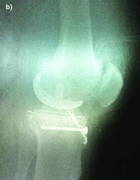 b. Intraoperative fixation of the intercondylar eminence, lateral view ...