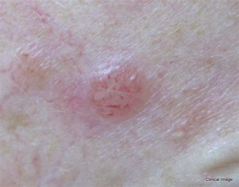 Basal Cell Carcinoma