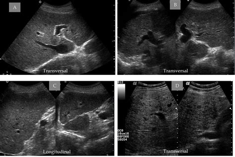 Ultrasonic Imaging In Liver Disease From Bench To Bedside Intechopen