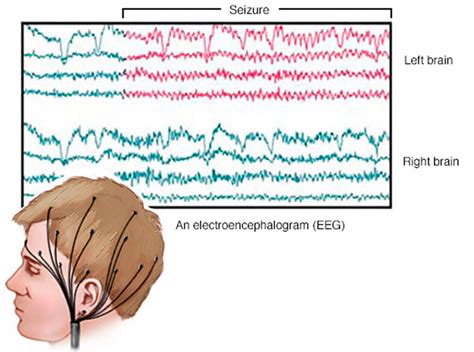 Grand Mal Seizure Causes Symptoms After Effects Recovery Time