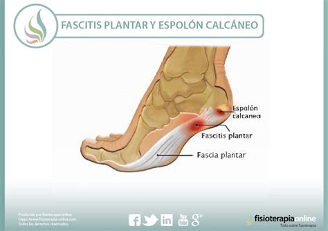 Fascitis plantar y espolón calcáneo qué son y cómo se tratan