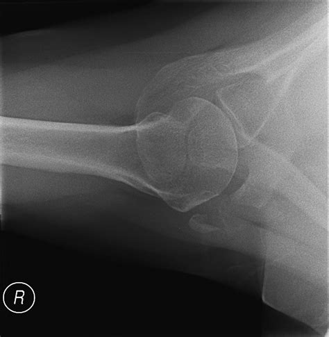 Avulsion Fracture Of The Coracoid Process Emergency Medicine Journal