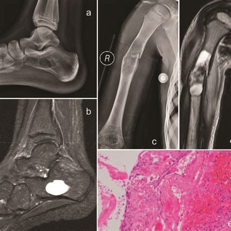 Radiograph Demonstrating A Centrally Located Lytic Lesion In The Download Scientific Diagram