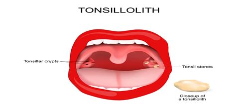 White Spots On Tonsils Causes And Treatment