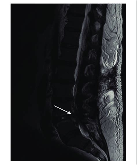 Magnetic Resonance Imaging Of The Lumbar Spine Performed Without The