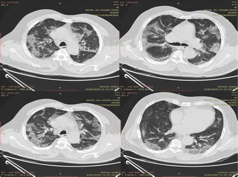 Bilateral And Peripheral Ground Glass Pulmonary Opacities Download Scientific Diagram