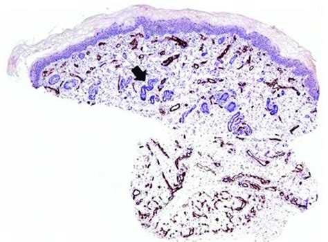 Biopsy Specimen From The Skin Lesion Shows Dilated Capillaries In The